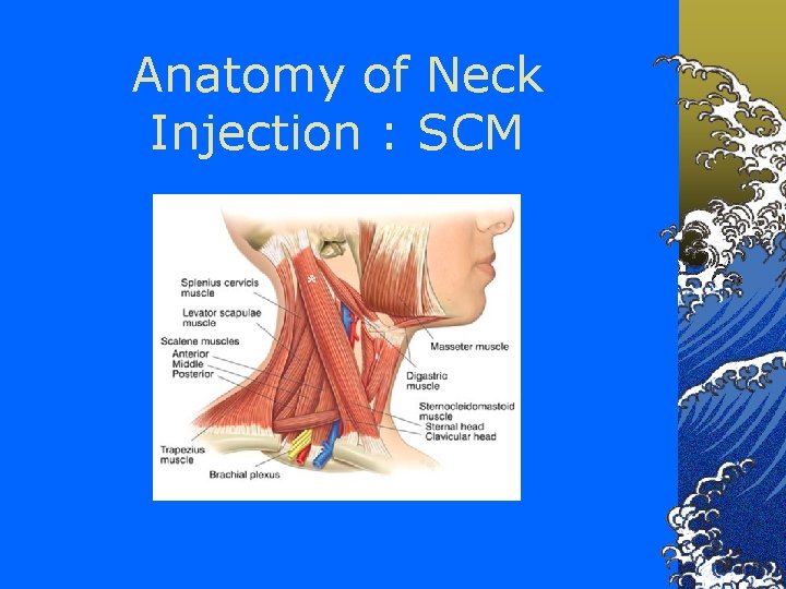 Anatomy of Neck Injection : SCM * 