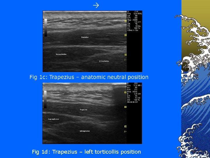  Fig 1 d: Trapezius – left torticollis position 