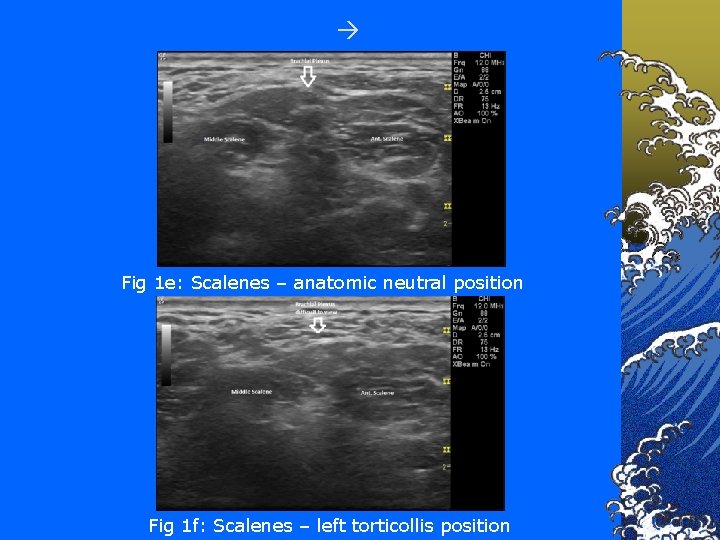  Fig 1 e: Scalenes – anatomic neutral position Fig 1 f: Scalenes –