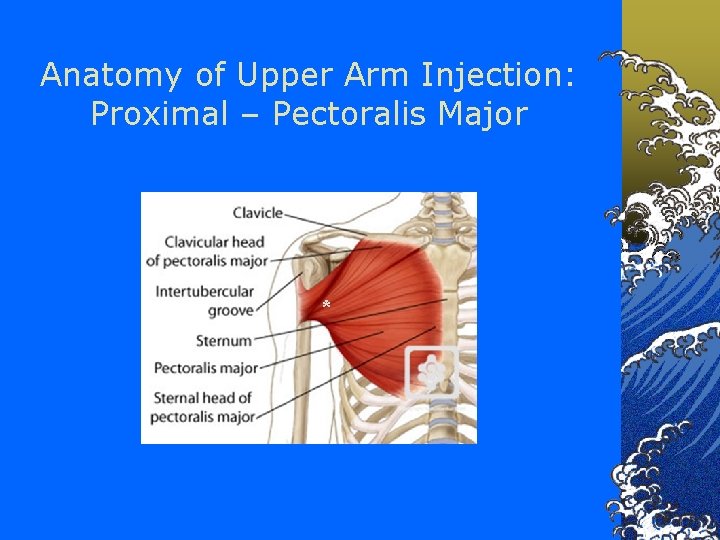 Anatomy of Upper Arm Injection: Proximal – Pectoralis Major * 