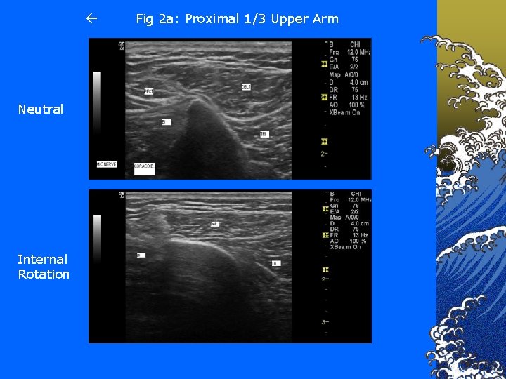  Neutral Internal Rotation Fig 2 a: Proximal 1/3 Upper Arm 