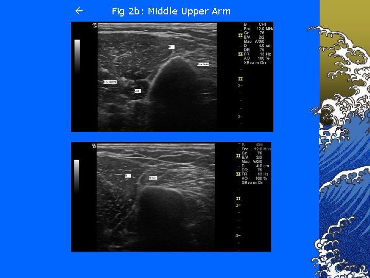  Fig 2 b: Middle Upper Arm 