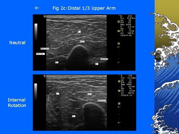  Neutral Internal Rotation Fig 2 c: Distal 1/3 Upper Arm 