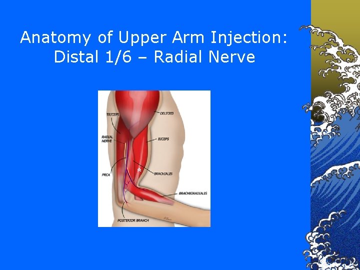 Anatomy of Upper Arm Injection: Distal 1/6 – Radial Nerve * 