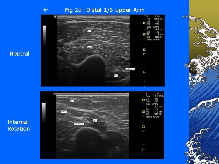  Neutral Internal Rotation Fig 2 d: Distal 1/6 Upper Arm 