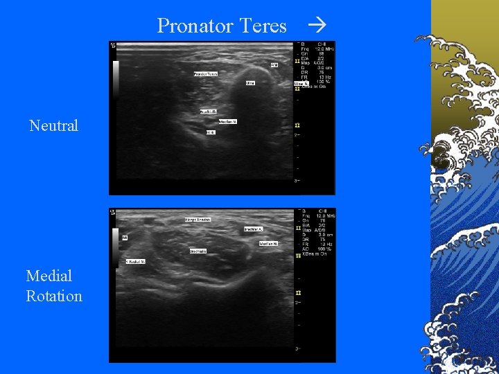 Pronator Teres Neutral Medial Rotation 