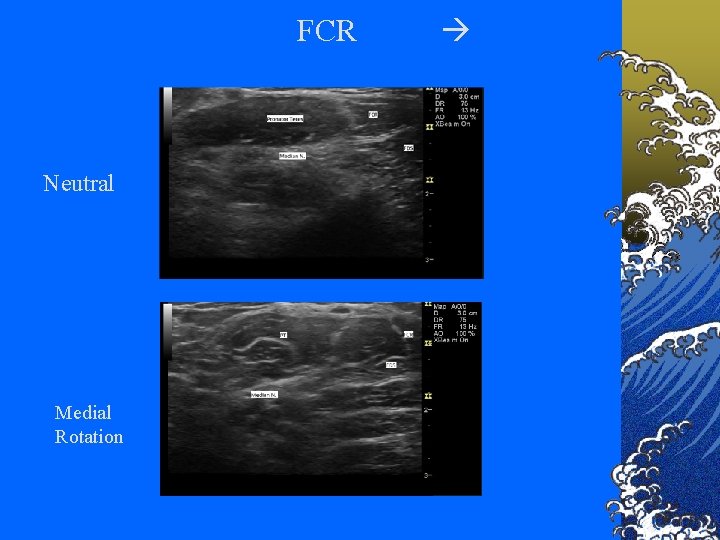 FCR Neutral Medial Rotation 