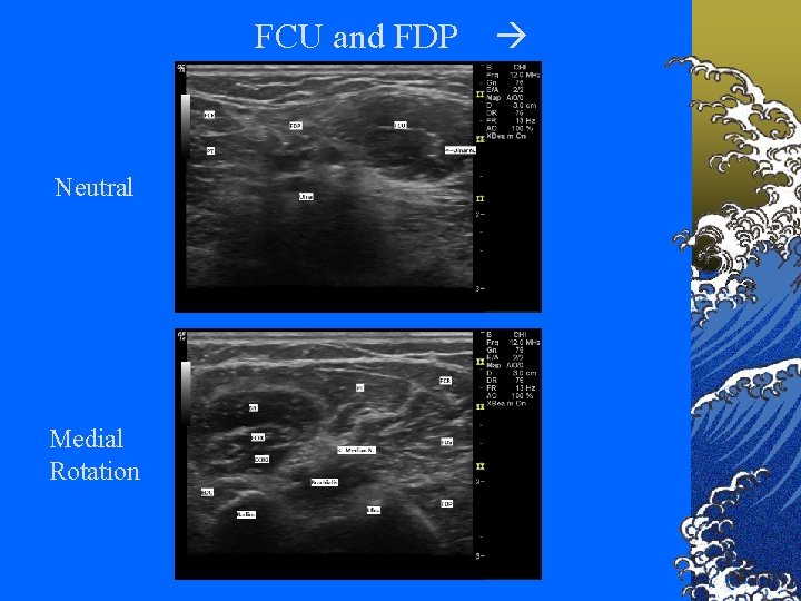 FCU and FDP Neutral Medial Rotation 