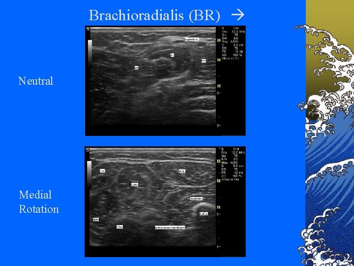 Brachioradialis (BR) Neutral Medial Rotation 