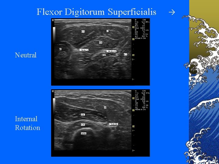 Flexor Digitorum Superficialis Neutral Internal Rotation 