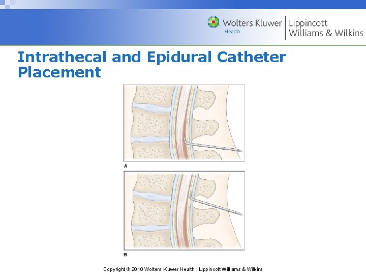 Intrathecal and Epidural Catheter Placement Copyright © 2010 Wolters Kluwer Health | Lippincott Williams