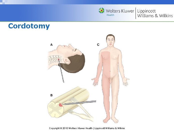 Cordotomy Copyright © 2010 Wolters Kluwer Health | Lippincott Williams & Wilkins 