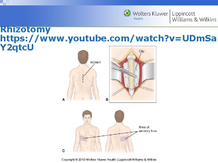 Rhizotomy https: //www. youtube. com/watch? v=UDm. Sa Y 2 qtc. U Copyright © 2010