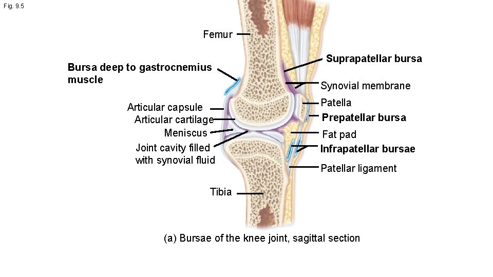 Fig. 9. 5 Femur Bursa deep to gastrocnemius muscle Articular capsule Articular cartilage Meniscus