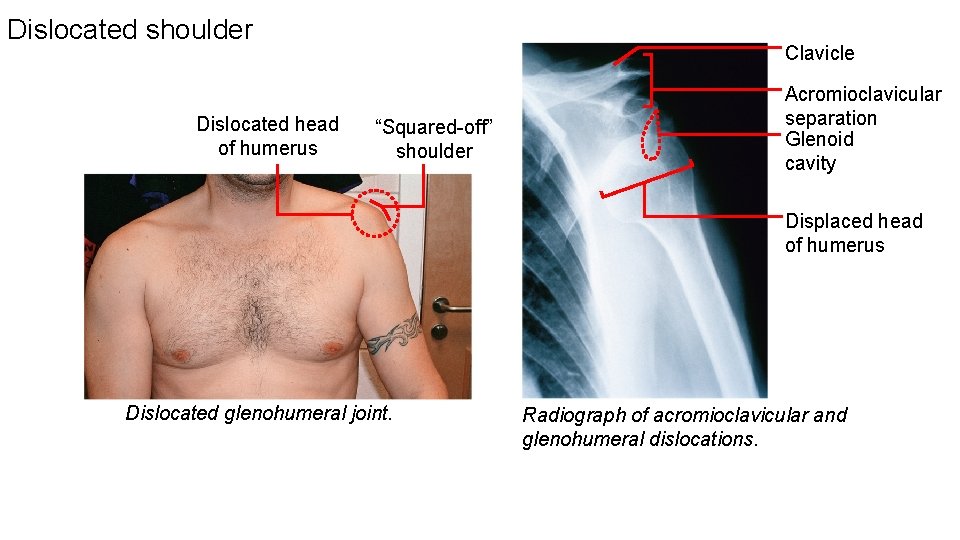 Dislocated shoulder Dislocated head of humerus Clavicle “Squared-off” shoulder Acromioclavicular separation Glenoid cavity Displaced