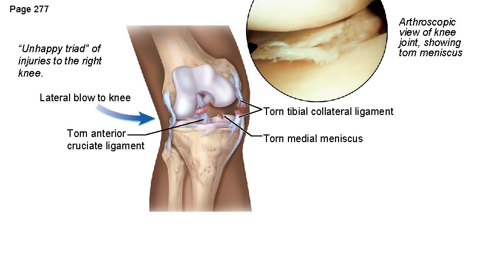 Page 277 Arthroscopic view of knee joint, showing torn meniscus “Unhappy triad” of injuries