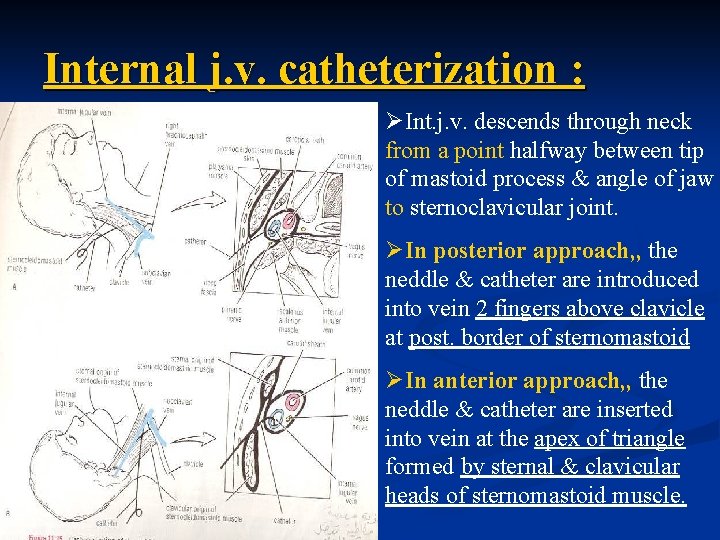 Internal j. v. catheterization : ØInt. j. v. descends through neck from a point