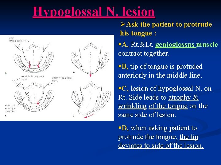 Hypoglossal N. lesion ØAsk the patient to protrude his tongue : §A, Rt. &Lt.