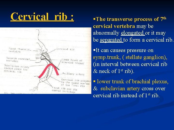 Cervical rib : §The transverse process of 7 th cervical vertebra may be abnormally