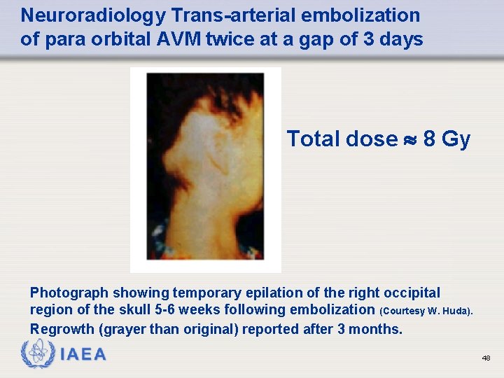 Neuroradiology Trans-arterial embolization of para orbital AVM twice at a gap of 3 days