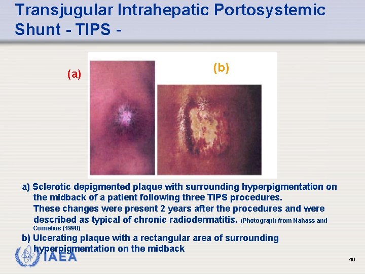 Transjugular Intrahepatic Portosystemic Shunt - TIPS (a) (b) a) Sclerotic depigmented plaque with surrounding