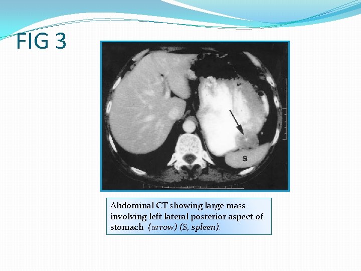 FIG 3 Abdominal CT showing large mass involving left lateral posterior aspect of stomach