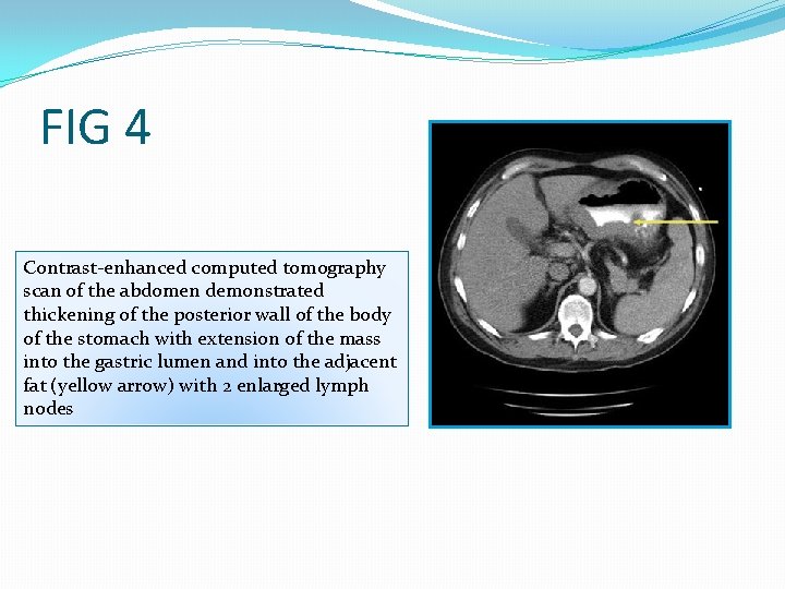 FIG 4 Contrast-enhanced computed tomography scan of the abdomen demonstrated thickening of the posterior