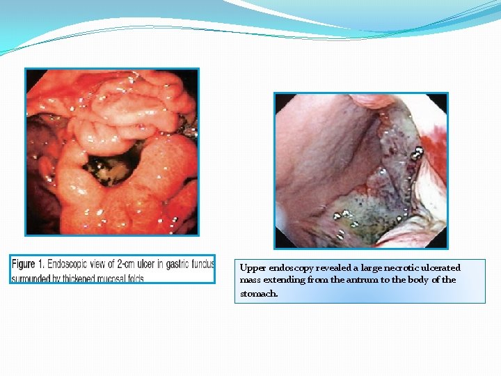 Upper endoscopy revealed a large necrotic ulcerated mass extending from the antrum to the