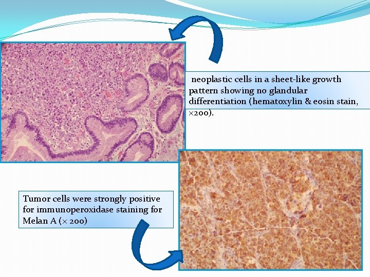  neoplastic cells in a sheet-like growth pattern showing no glandular differentiation (hematoxylin &