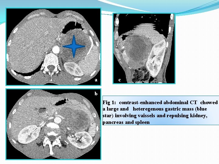 a c b Fig 1: contrast-enhanced abdominal CT chowed a large and heteregenous gastric