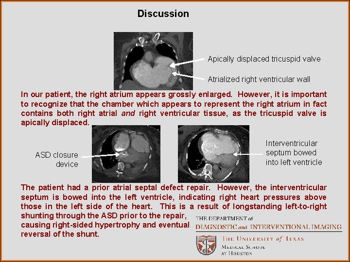 Discussion Apically displaced tricuspid valve Atrialized right ventricular wall In our patient, the right