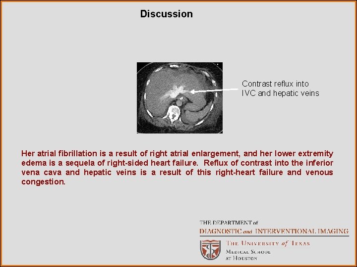 Discussion Contrast reflux into IVC and hepatic veins Her atrial fibrillation is a result