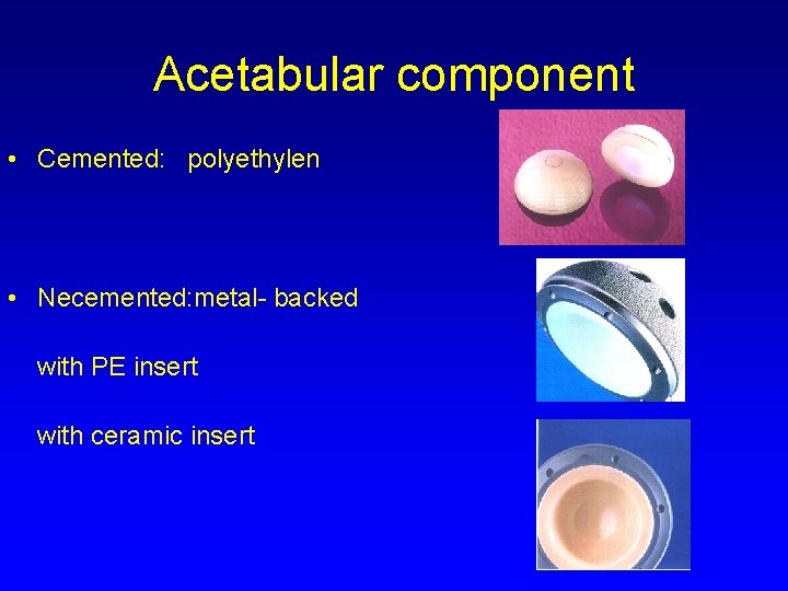 Acetabular component • Cemented: polyethylen • Necemented: metal- backed with PE insert with ceramic