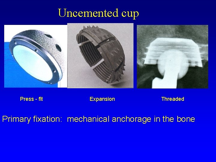 Uncemented cup Press - fit Expansion Threaded Primary fixation: mechanical anchorage in the bone