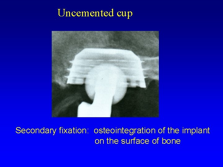 Uncemented cup Secondary fixation: osteointegration of the implant on the surface of bone 