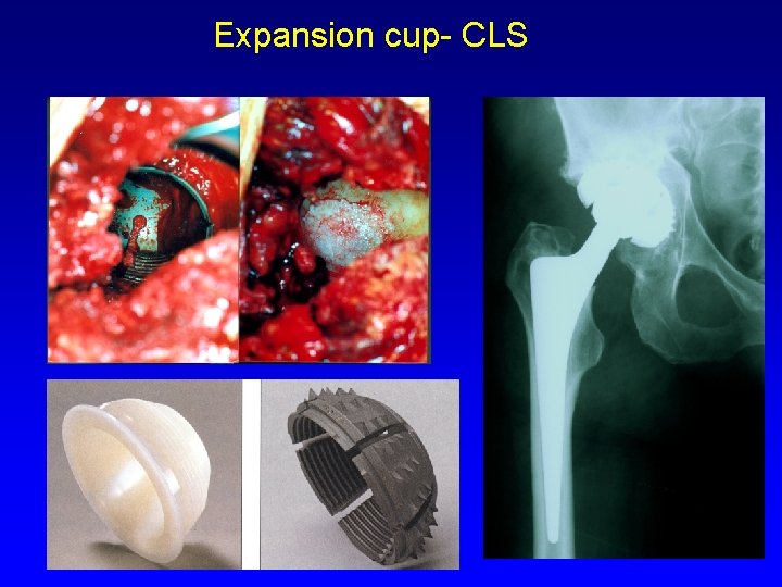 Expansion cup- CLS 