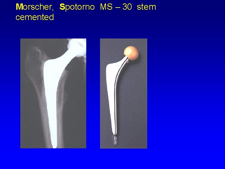 Morscher, Spotorno MS – 30 stem cemented 