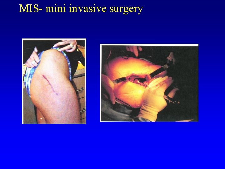 MIS- mini invasive surgery 