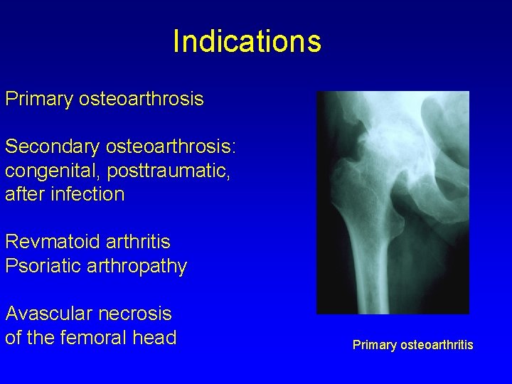 Indications Primary osteoarthrosis Secondary osteoarthrosis: congenital, posttraumatic, after infection Revmatoid arthritis Psoriatic arthropathy Avascular