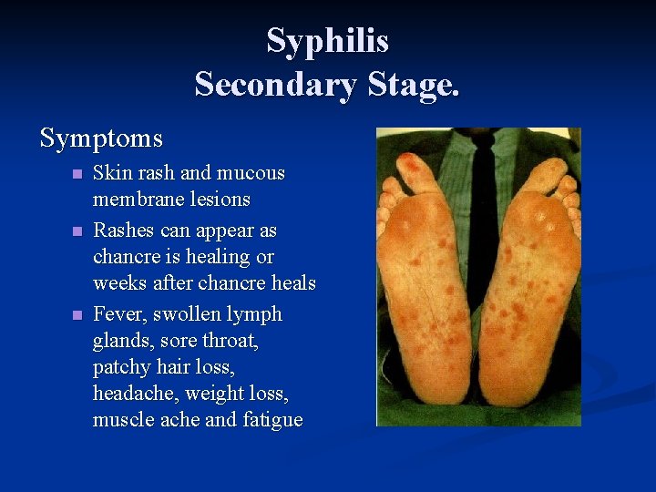 Syphilis Secondary Stage. Symptoms n n n Skin rash and mucous membrane lesions Rashes