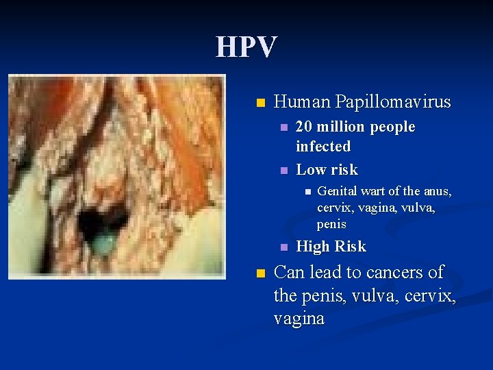 HPV n Human Papillomavirus n n 20 million people infected Low risk n n