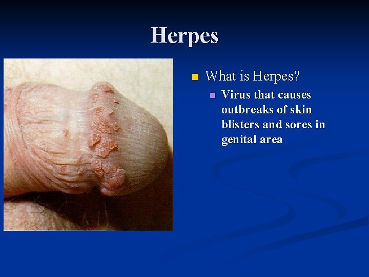 Herpes n What is Herpes? n Virus that causes outbreaks of skin blisters and