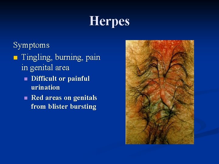 Herpes Symptoms n Tingling, burning, pain in genital area n n Difficult or painful