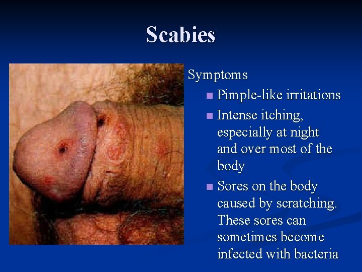 Scabies Symptoms n Pimple-like irritations n Intense itching, especially at night and over most