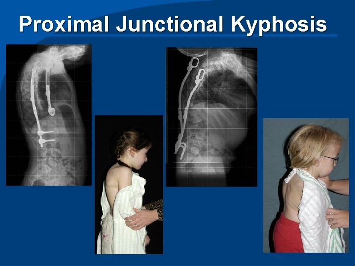 Proximal Junctional Kyphosis 