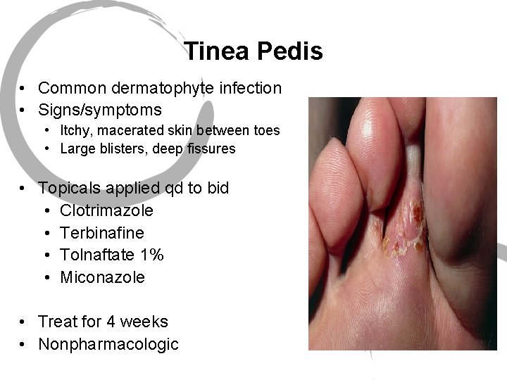 Tinea Pedis • Common dermatophyte infection • Signs/symptoms • Itchy, macerated skin between toes