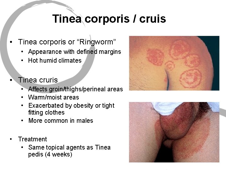 Tinea corporis / cruis • Tinea corporis or “Ringworm” • Appearance with defined margins