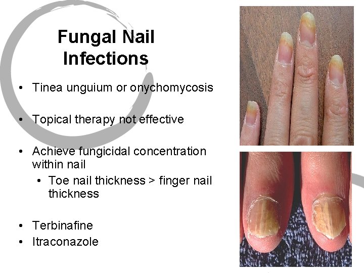 Fungal Nail Infections • Tinea unguium or onychomycosis • Topical therapy not effective •