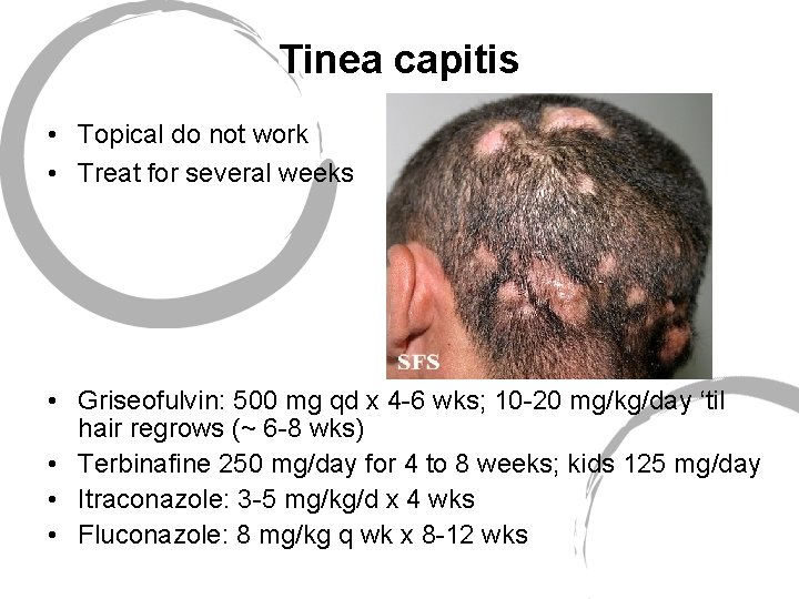 Tinea capitis • Topical do not work • Treat for several weeks • Griseofulvin: