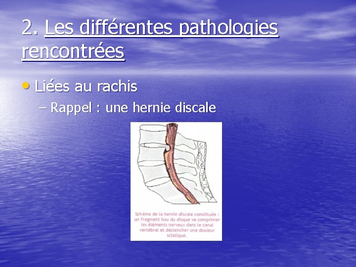 2. Les différentes pathologies rencontrées • Liées au rachis – Rappel : une hernie